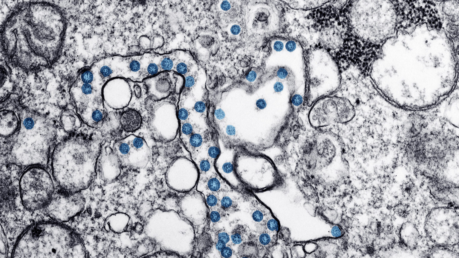 Transmission electron microscopic image of COVID-19.