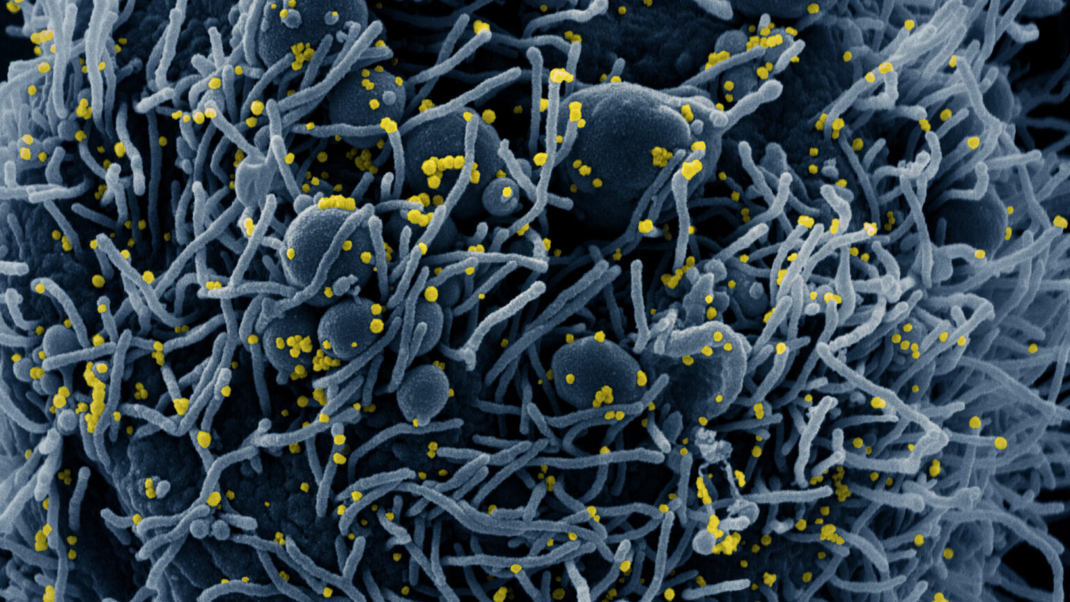 Colorized scanning electron micrograph of an apoptotic cell (blue) infected with SARS-COV-2 virus particles (yellow), isolated from a patient sample. Image captured at the NIAID Integrated Research Facility (IRF) in Fort Detrick, Maryland. (Courtesy: NIAID)