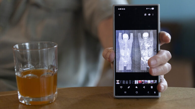 Earl Lowrie holds a smartphone displayed vertically on the surface of a table, with its screen showing side-by-side X-ray images of a human body, with a glass of a beverage also on the table's surface.